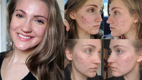 How Im Healing My Adult Cystic Hormonal Acne Naturally Without Accutane Or Medications Youtube