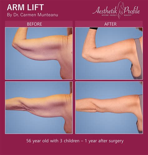 Arm Lift Faqs Frequently Asked Questions Dr Carmen Munteanu Ps