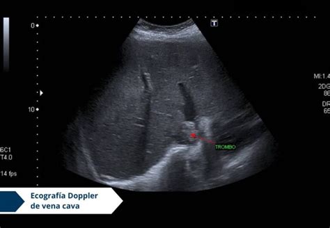 Ecografía Doppler De Vena Cava Ecodoppler Vascular I Doppler En Bogotá