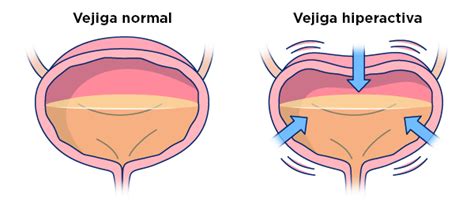 Informaci N Sobre La Vejiga Hiperactiva Vh Memorial Sloan Kettering