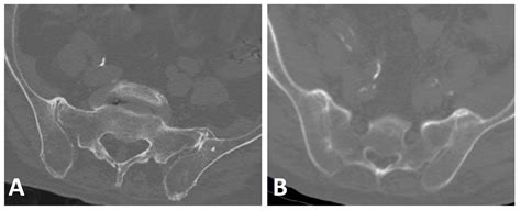 Diagnostics Free Full Text Imaging Characteristics Of Diffuse Idiopathic Skeletal