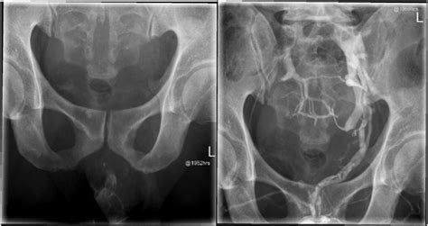 Retrograde Urethrogram Showing Contrast Extravasation Into The Pelvic Download Scientific