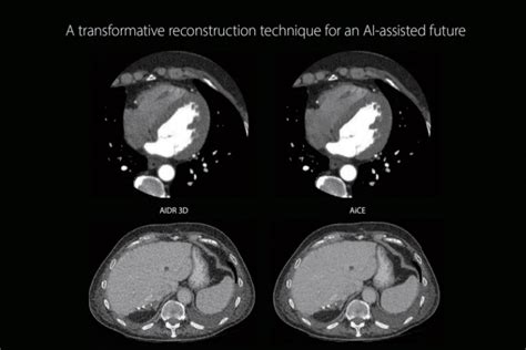 State Of The Art Ct Scan For Heart Melbourne Heart Care