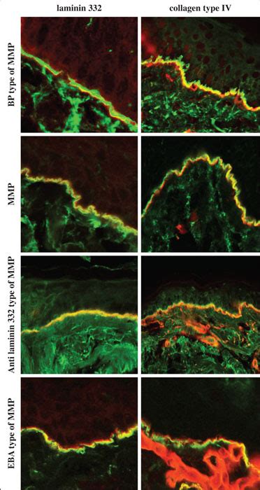 Jle European Journal Of Dermatology Diagnosis Of Autoimmune