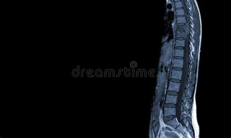 Mri Thoracic Spine Sagittal History Of Back Pain With Compression