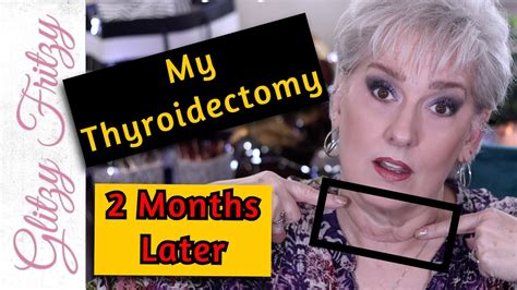 Thyroidectomy 2 Months Later With Daily Pictures YouTube