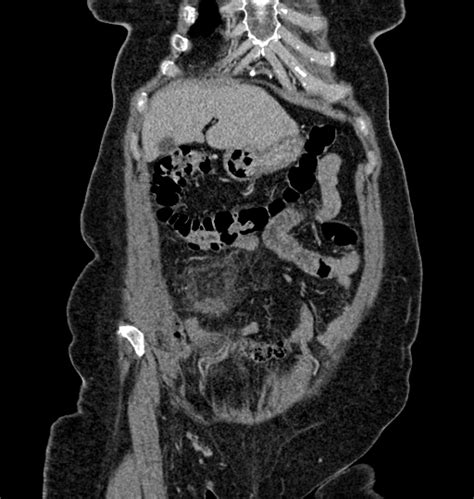 Omental Infarction Image Radiopaedia Org