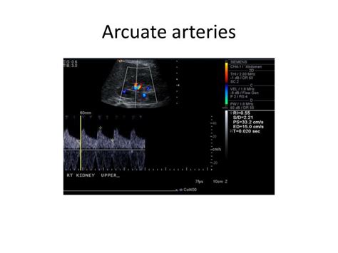 PPT - Renal artery Ultrasound study PowerPoint Presentation - ID:2930480