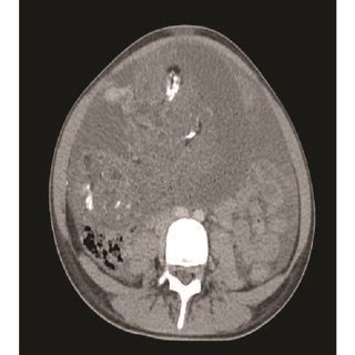 Initial Imaging Computed Tomography Of The Abdomen And Pelvis