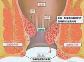 大腸鏡檢查有痔瘡！該治療嗎？ 秤子維的秘密花園 Udn部落格