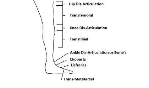 Lower Limb Amputation Levels