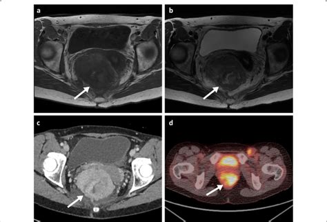 Mri T Wi And T Wi Axial A B Portal Phase Contrast Enhanced Ct Axial