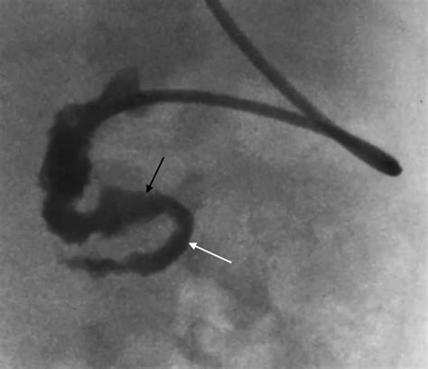 Diagnostic Decision Making Tool For Imaging Term Neonatal Bowel