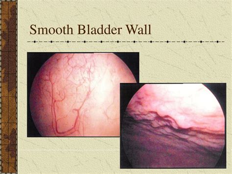 PPT Endoscopy And Radiology For Lower Urinary Tract Dysfunction