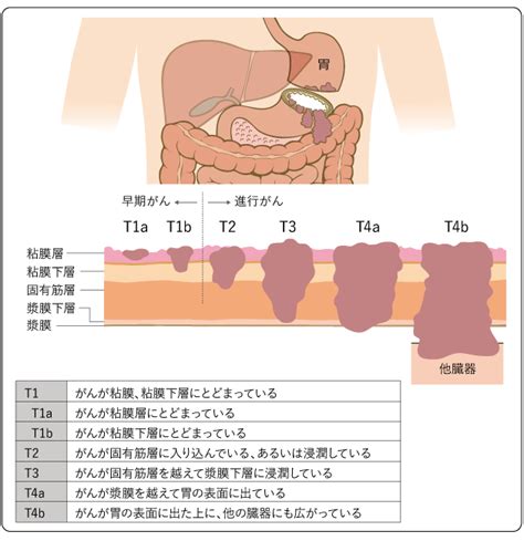 胃がん 全ページ 国立がん研究センター がん情報サービス 一般の方へ