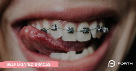 Self Ligating Braces Orthodontist Insights