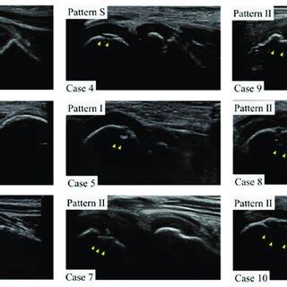 Ultrasound images of the lateral elbow for each case in this study. For ...