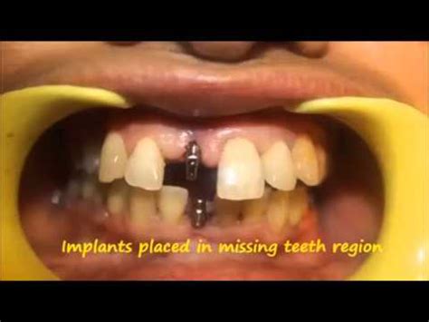 Dental Implant Center Chennai Tooth Replacement Tamil Nadu YouTube