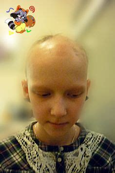 Children Hair Loss, Alopecia Areata, Alopecia Totalis, and Alopecia ...