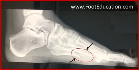 5th Metatarsal Shaft Dancer S Fracture FootEducation