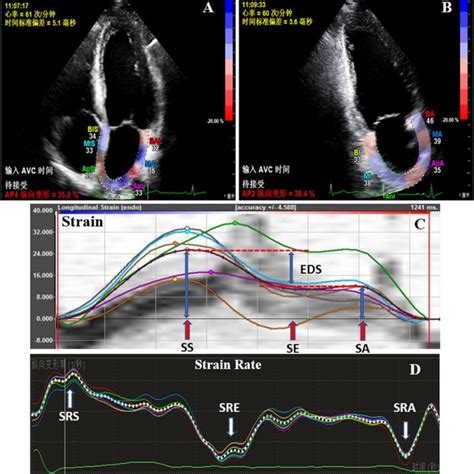 A Apical 4 Chamber View B Apical 2 Chamber View C Strain Curve