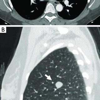 Contrast Enhanced Ct Of The Chest In A Axial Plane With Soft Tissue