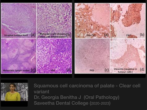 Clear Cell Variant Of Scc — Oral Pathology Saveetha