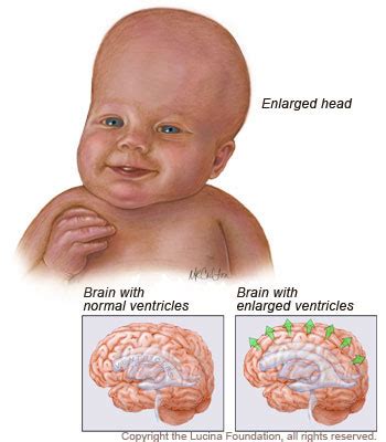 Symptoms - Hydrocephalus