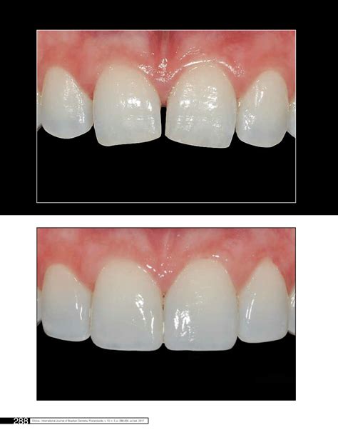 Pdf Recontorno Dental E Fechamento De Diastemas Com Resina Composta