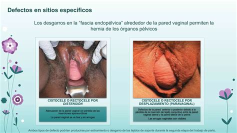 Prolapso De Organos Pelvicos Ppt