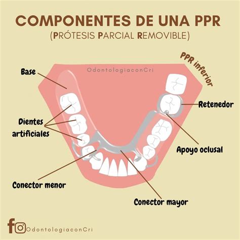 Componentes de una prótesis parcial removible PPR en 2023