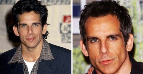 Ben Stiller Before and After Plastic Surgery: Ears, Nose, Face