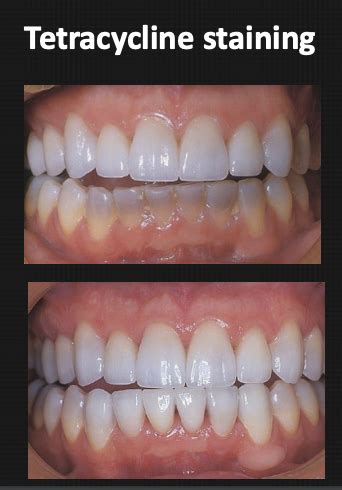 5 - Ceramic Veneers Indications and Preparations Part I Flashcards ...