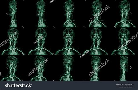 Collection Mra Brain Magnetic Resonance Angiography Stock Photo ...