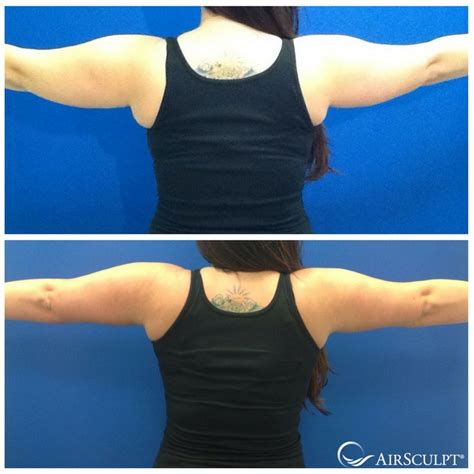 Pin On Airsculpt® Before And After Elite Body Sculpture