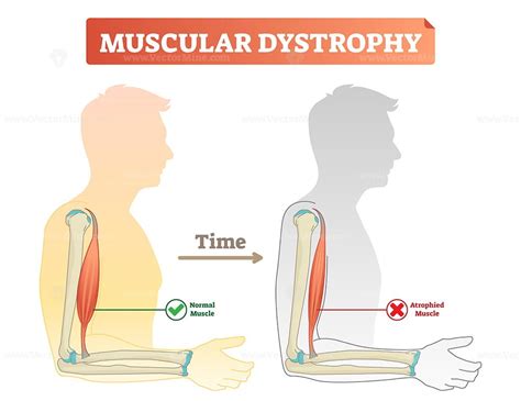 Vector illustration about muscular dystrophy – VectorMine