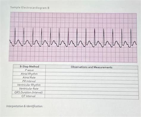 Solved Sample Electrocardiogram B Interpretation \& | Chegg.com