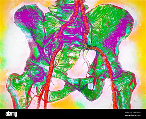 iliac arteries ct scan stock photo alamy