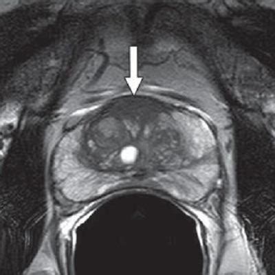 Mri Guided Prostate Biopsies Improve Cancer Detection