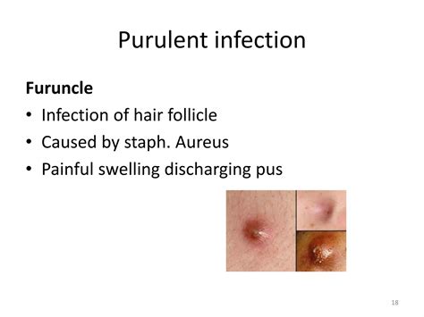 Soft Tissue Infection Ppt