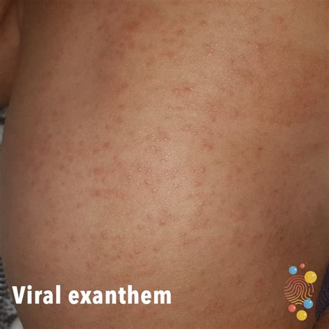 Viral Exanthem Rash Baby