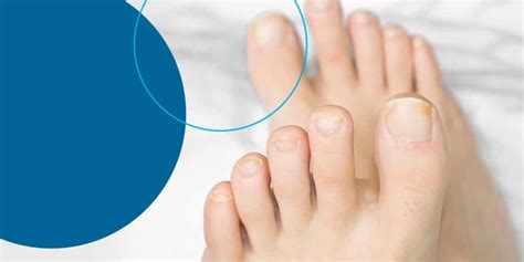 How To Prevent And Treat Toenail Fungus Fasa