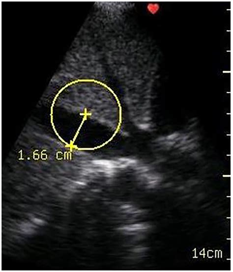 Ultrasound Image In The Longitudinal Orientation For Measurement Of The