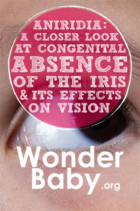 Aniridia: A Closer Look at Congenital Absence of the Iris and Its ...