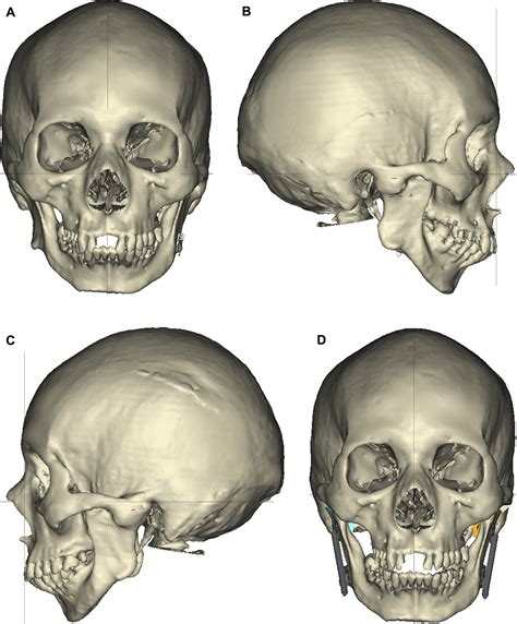 Accuracy of Virtual Surgical Planning in Treatment of Temporomandibular