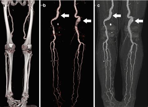 Upper Limb Angiogram Anatomy