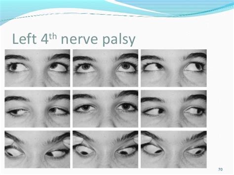 Paralytic Strabismus Features And Investigations Of Paretic Strabism