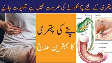 Pittay Ki Pathri Ka Ilaj In Urdu Gallstones Treatment In Urdu Hindi