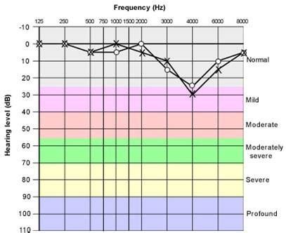 Hearing Test | ENT & Allergy Specialist | Canton