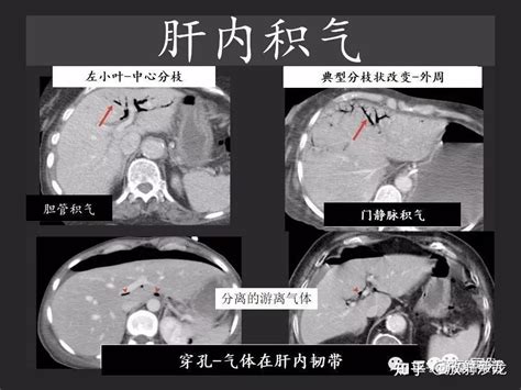 胃肠穿孔：气从哪里来？通过腹膜解剖确定穿孔部位 知乎